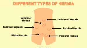 Can a Hernia Cause Erectile Dysfunction (ED)? Types Of Hernias